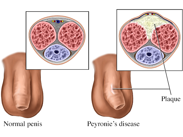 Peyronies Disease schematic