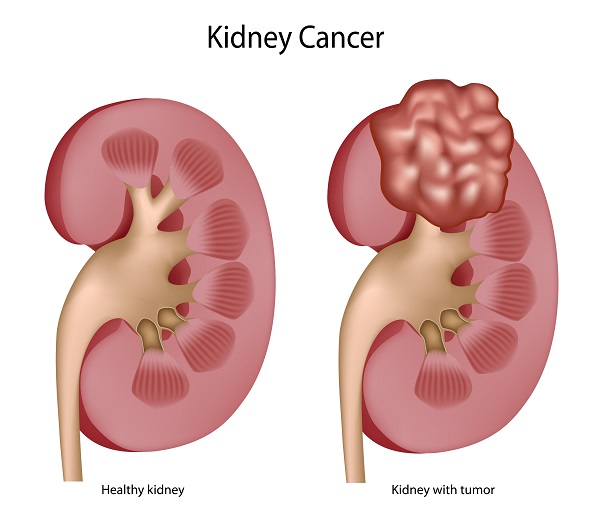 Kidney Tumor Size Chart