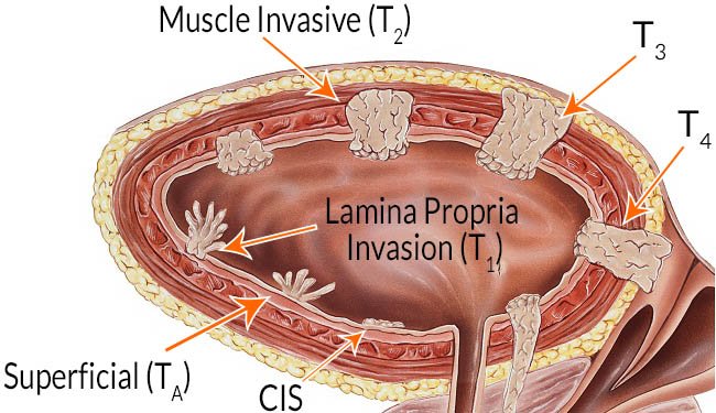 Types of Bladder Cancer