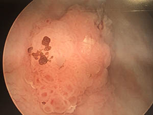 Bladder Tumor