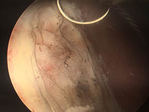 Bladder Wall after Tumor Removal