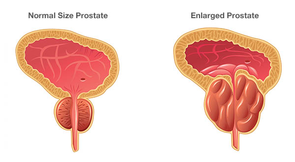 Is an enlarged prostate cancer