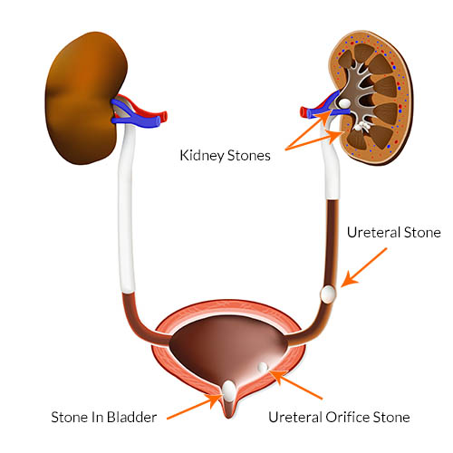 Kidney Stones: Emergency Department Diagnosis And Treatment