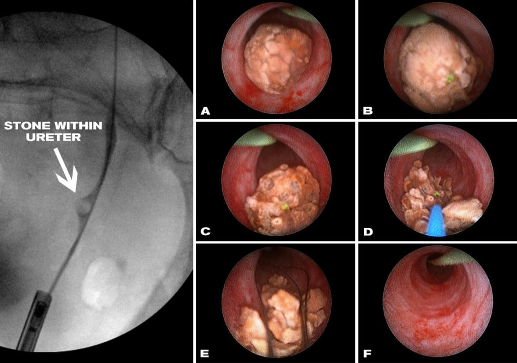 Ureteroscopy with Laser Lithotripsy Treatment for Kidney Stones Washington,  D.C., Maryland & Virginia